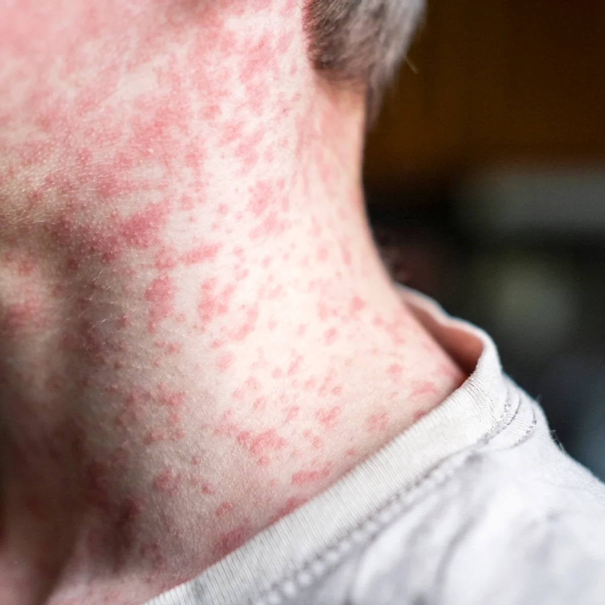 Sarampo nos EUA: Pensilvânia registra mais 55 novos casos da doença