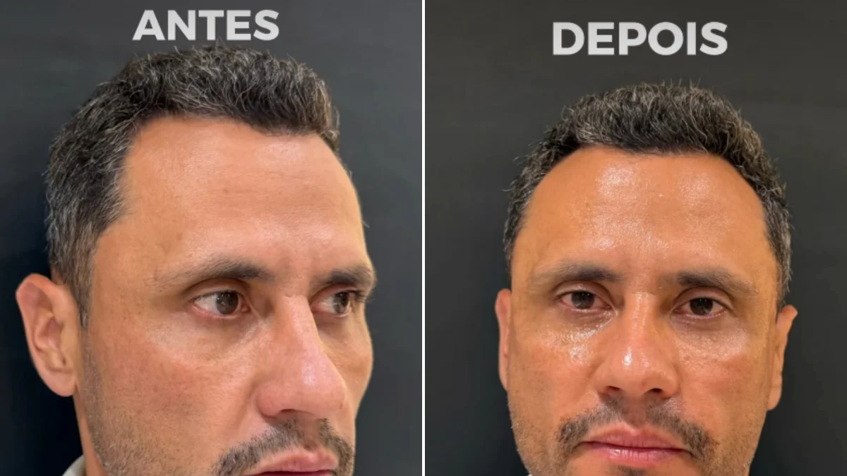 Eleito e harmonizado: Cleitinho faz procedimentos no rosto após campanha