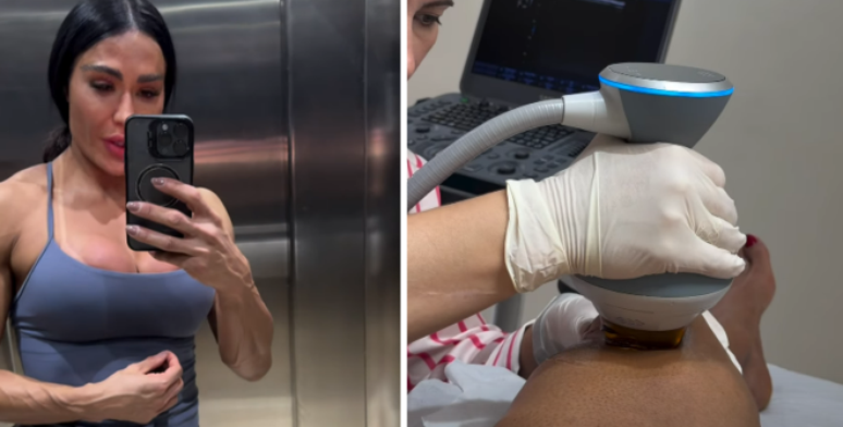 Gracyanne Barbosa recorre a punção para retirar líquido do joelho devido à 'Dança dos Famosos'